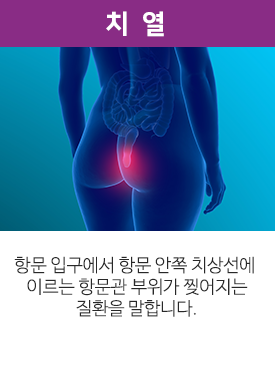 치열. 항문 입구에서 항문 안쪽 치상선에 이르는 항문관 부위가 찢어지는 질환을 말합니다.