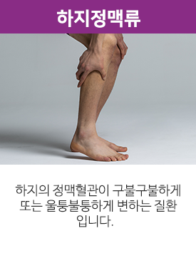 하지정맥류. 하지의 정맥혈관이 구불구불하게 또는 울퉁불퉁하게 변하는 질환입니다.